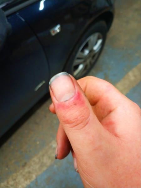 My not-quite-broken thumb